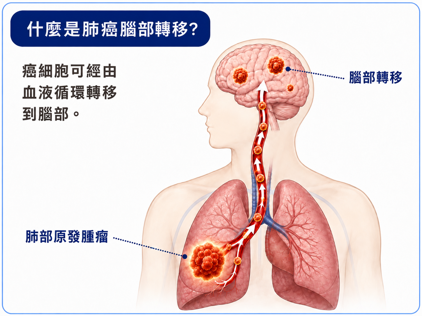 肺癌腦部轉移衛教專訪文章封面